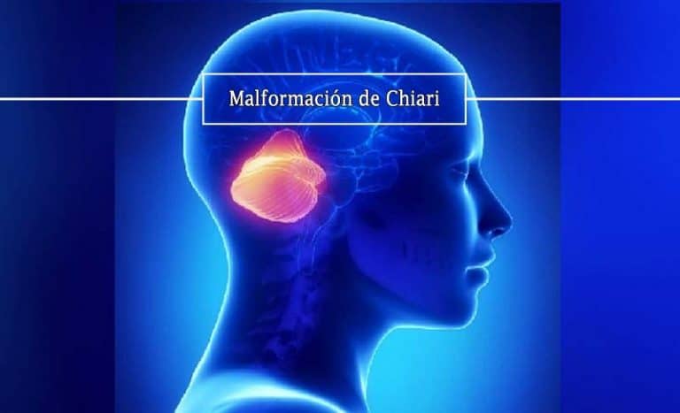 malformacion-de-chiari