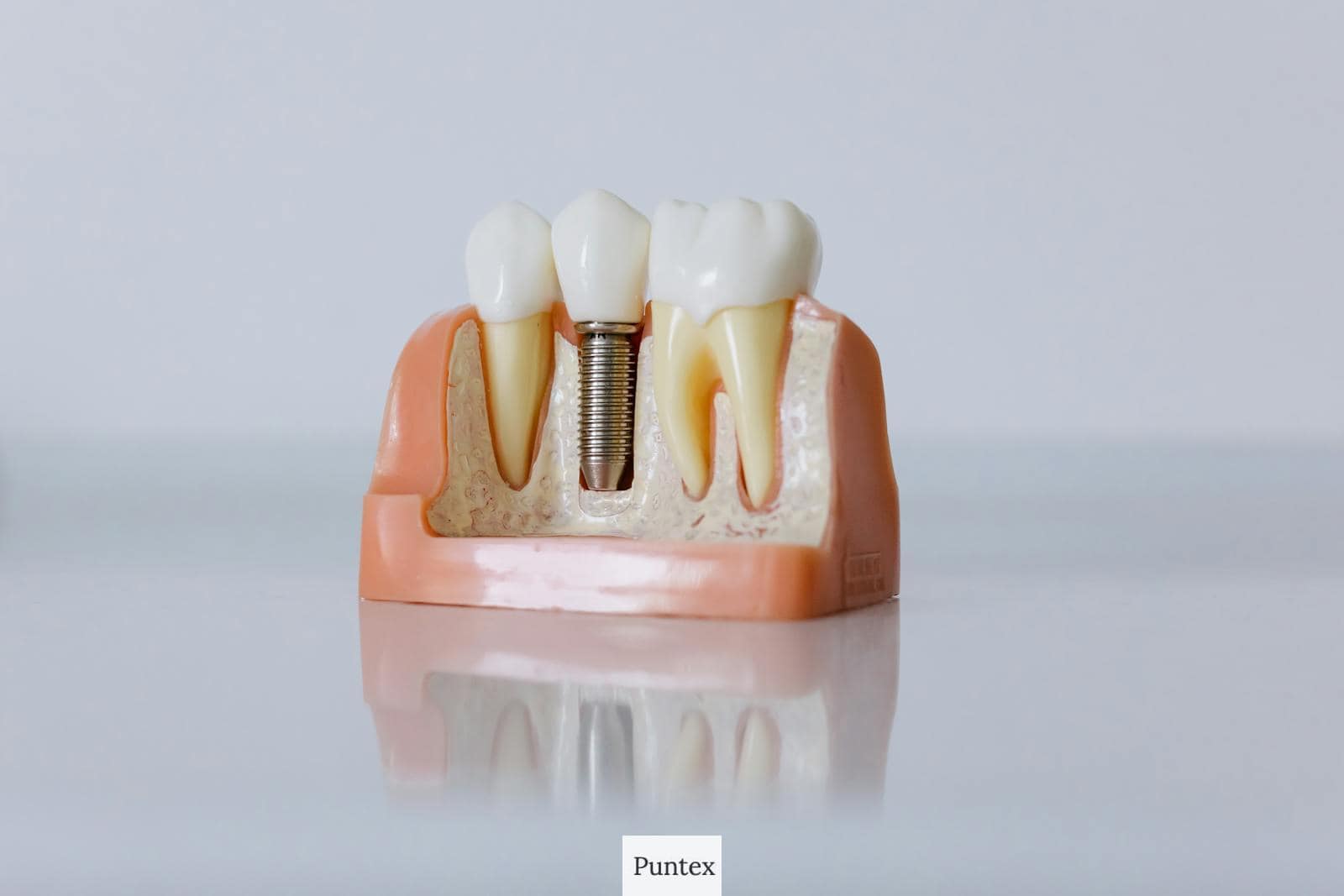 implantes dentales