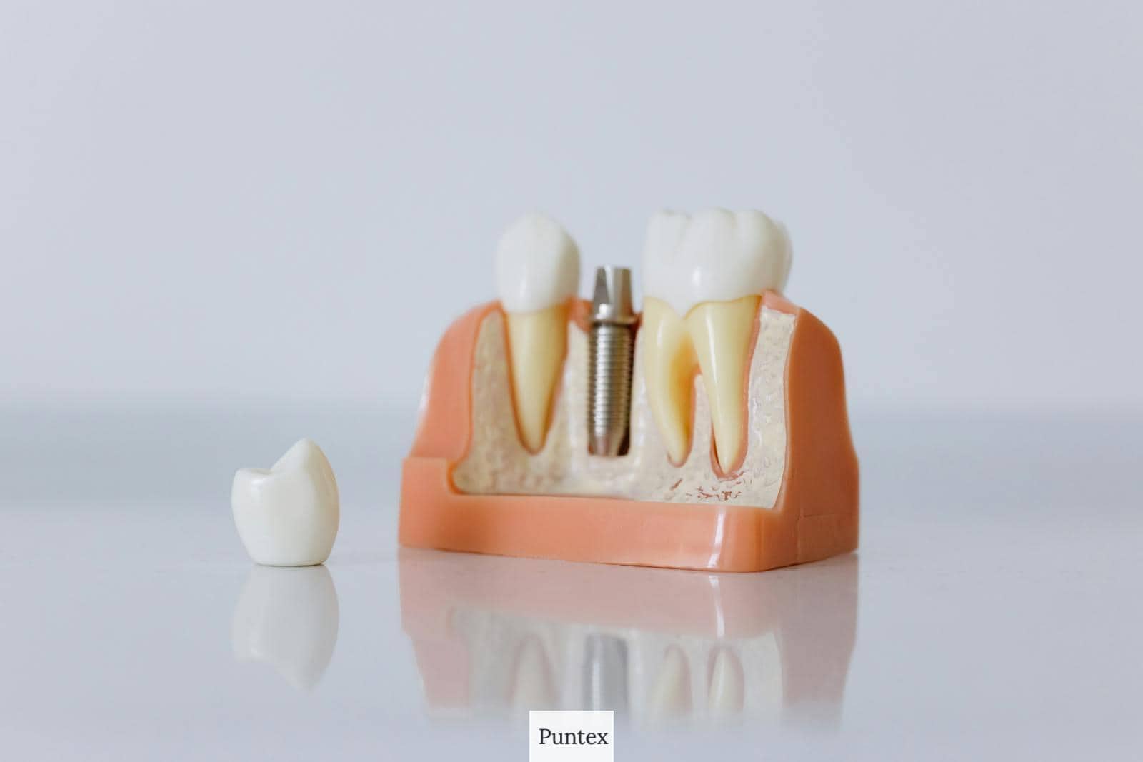 Guía completa de implantes dentales
